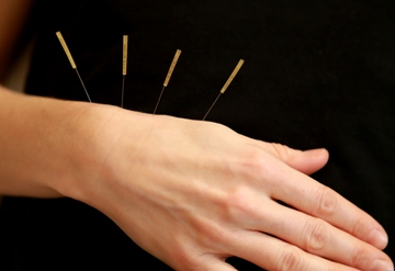 akupunktur nadeln